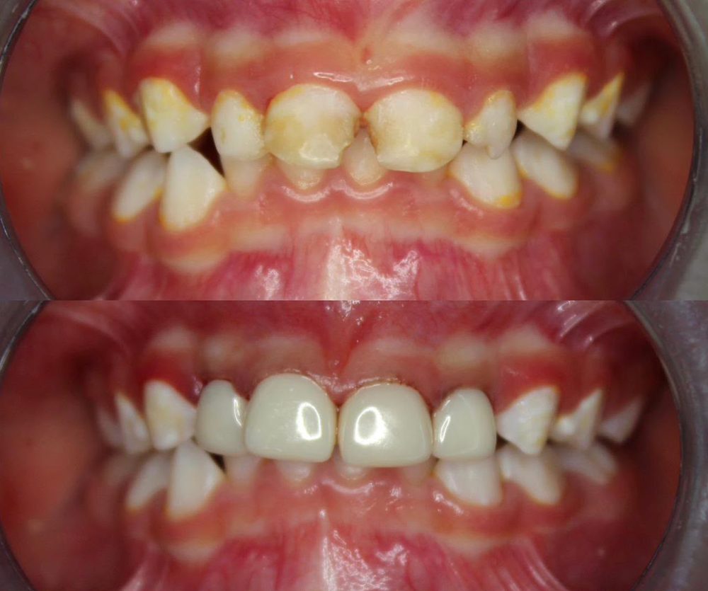 Paciente de 3 años de edad restaurado con 4 coronas de zirconia — caso real de Zibá Clínica Dental