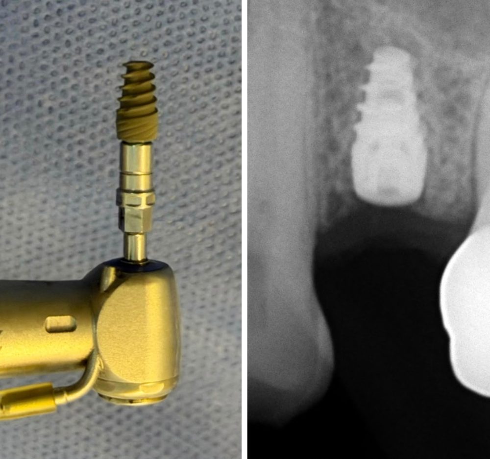 Implante dental — caso real de Zibá Clínica Dental