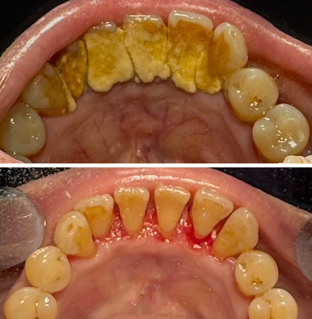 Limpieza dental — caso real de Zibá Clínica Dental