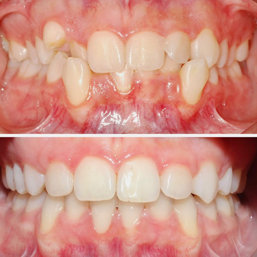 Ortodoncia — caso real de Zibá Clínica Dental
