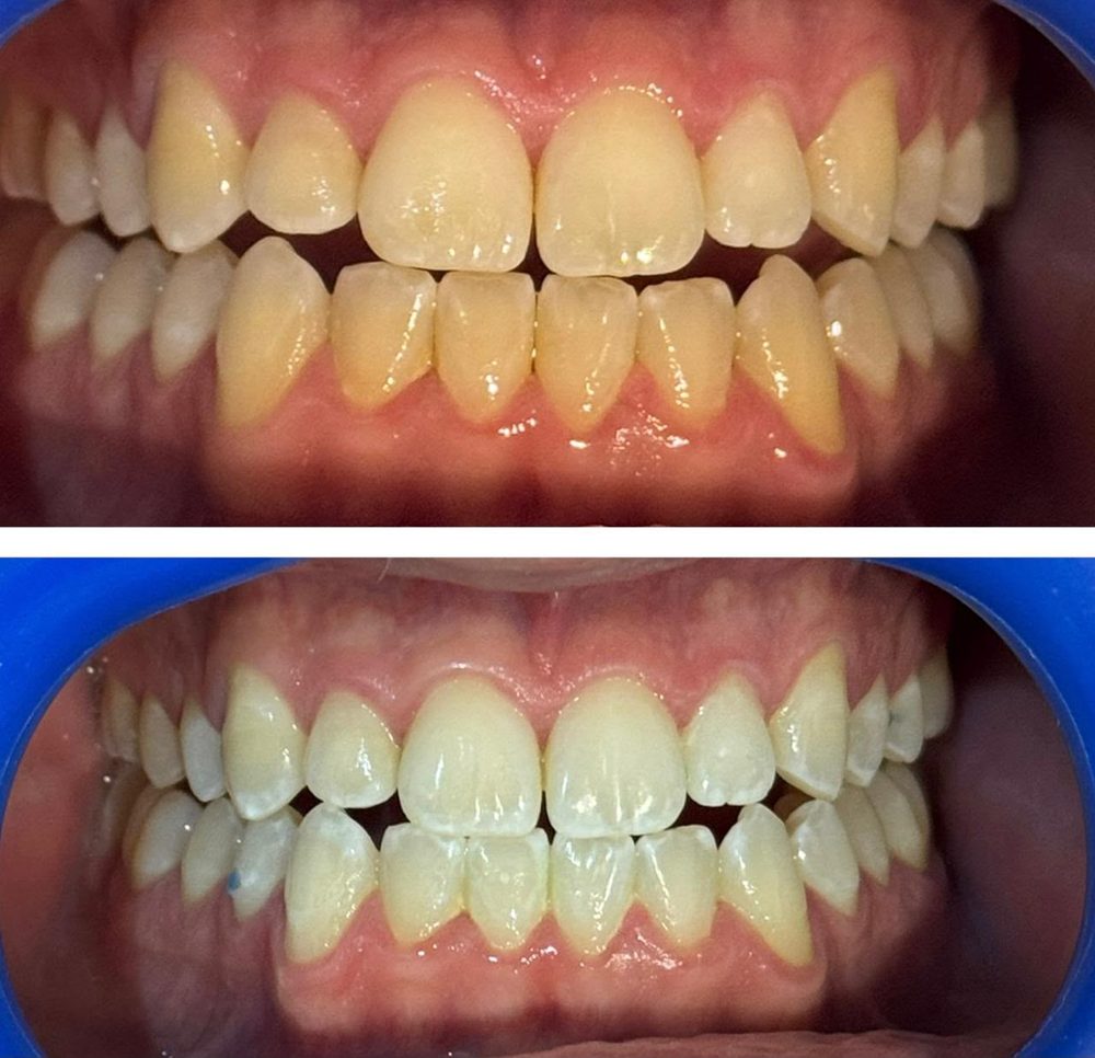 Blanqueamiento dental — caso real de Zibá Clínica Dental