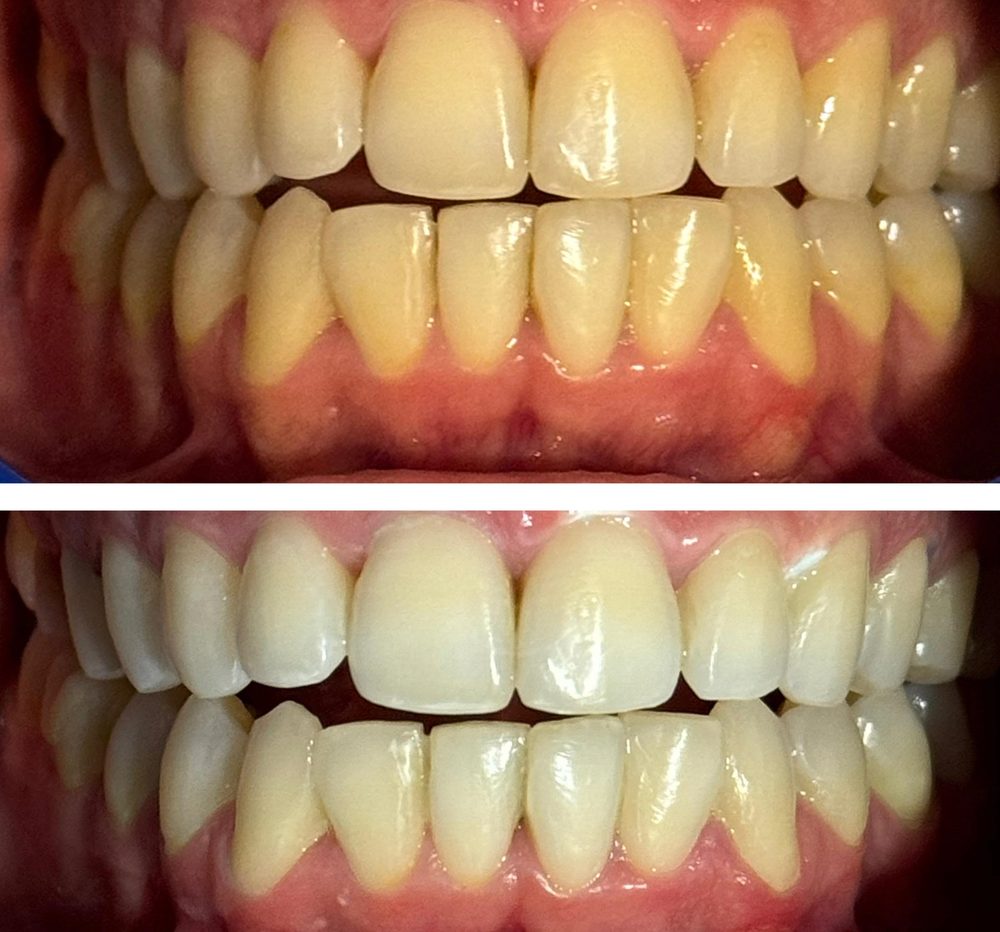 Blanqueamiento dental — caso real de Zibá Clínica Dental