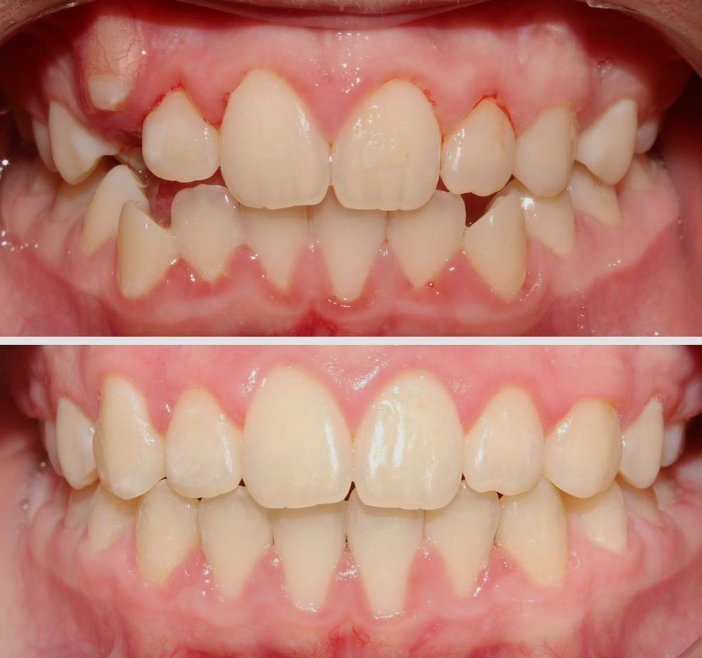 Ortodoncia — caso real de Zibá Clínica Dental
