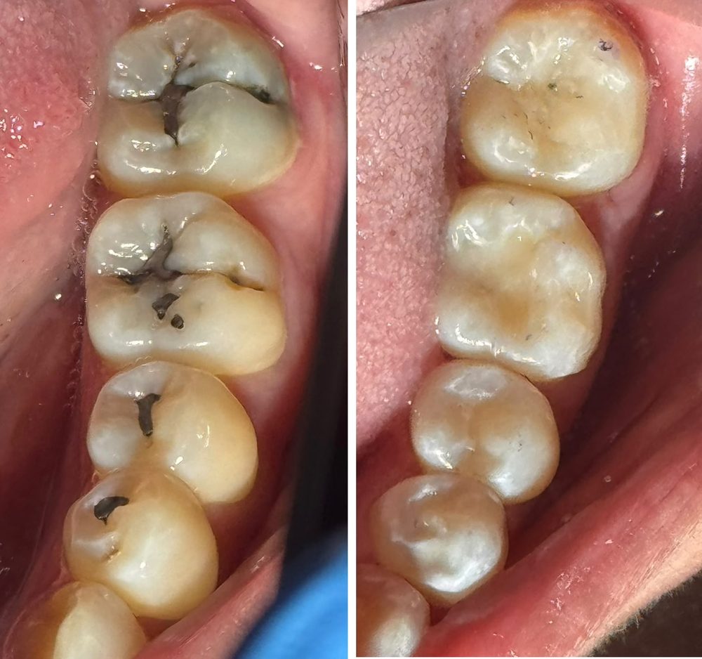 Cambio de amalgamas por resinas — caso real de Zibá Clínica Dental