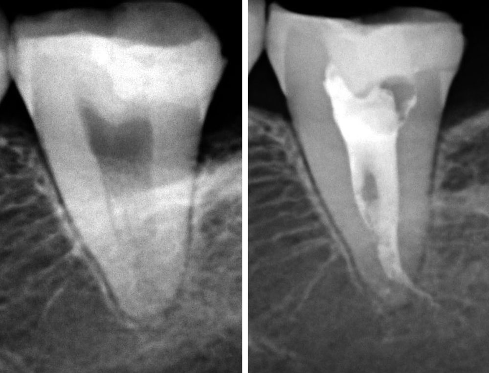 Endodoncia — caso real de Zibá Clínica Dental